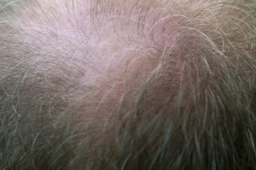greffe-cheveux