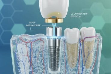 Quels sont les composants d’un implant dentaire ?